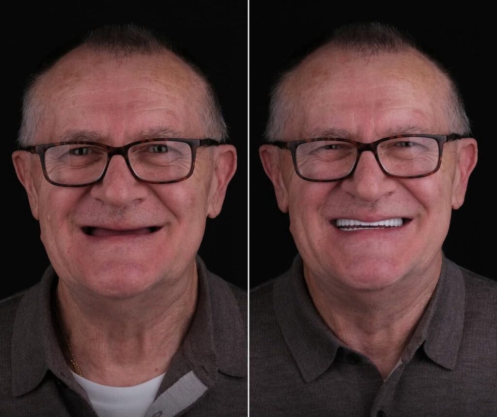 14 Implants and 28 Monolithic Zirconium Crowns in Bodrum