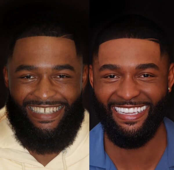 The Ultimate Smile Makeover