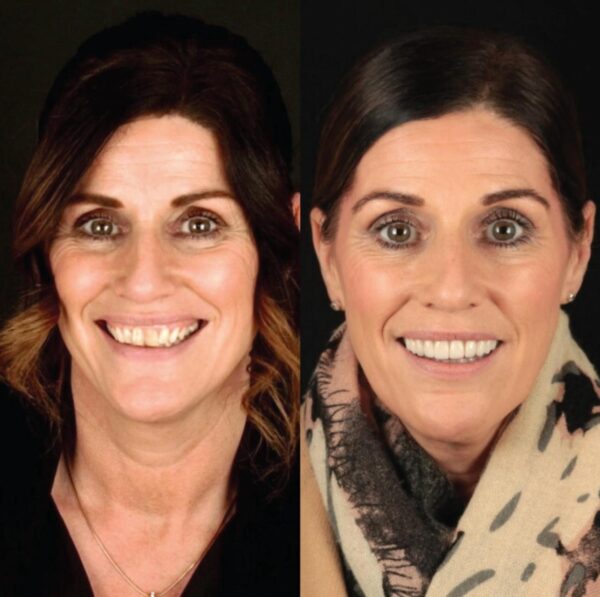 Full Mouth Dental Treatment in Bodrum