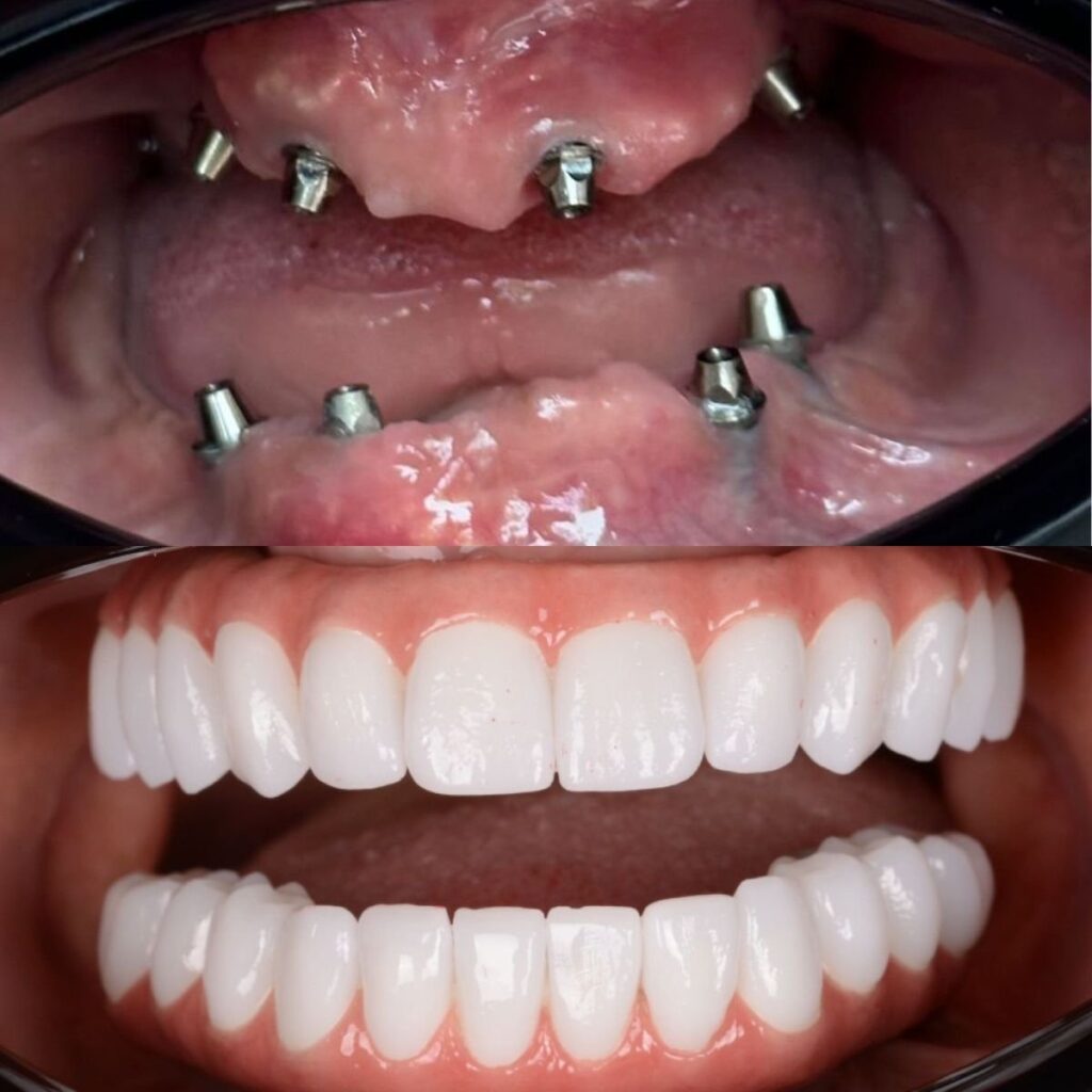 All onSix Dental Implants in Bodrum
