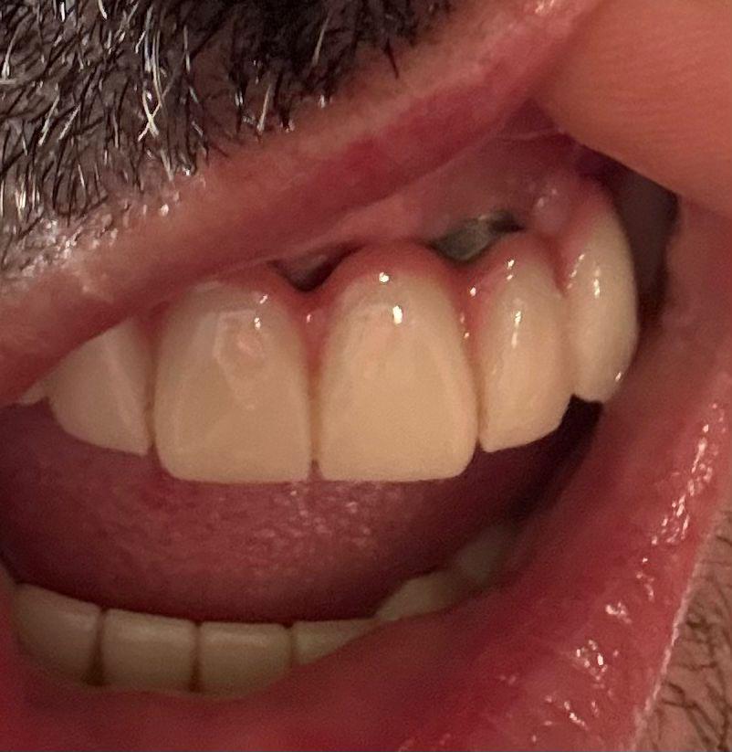 The Hidden Cost of Cheap Dental Implant Treatment