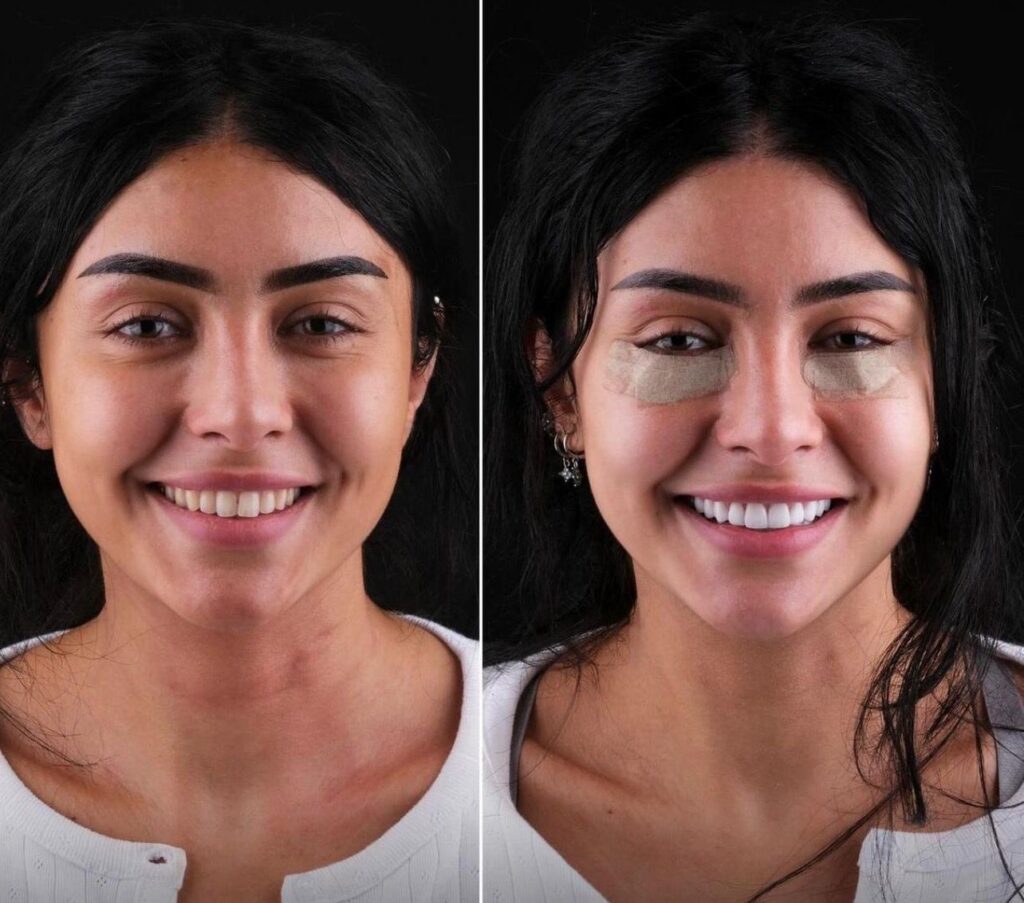 Porcelain crown before and after transformation Bodrum Turkey - woman smile makeover, dental veneers results, zirconia crowns Turkey cost, best cosmetic dentist Bodrum, teeth restoration before after photos, affordable dental work abroad