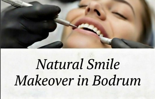Natural Smile Makeover in Bodrum